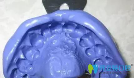 傳統(tǒng)口腔取模