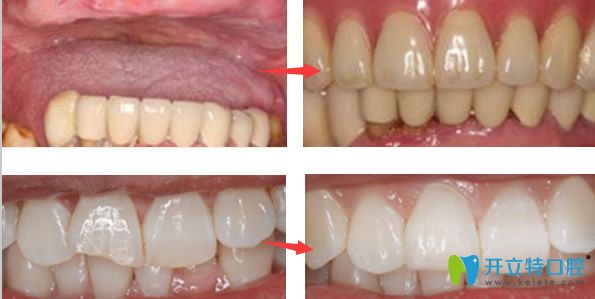 清華陽(yáng)光口腔陳清華醫(yī)生看牙效果