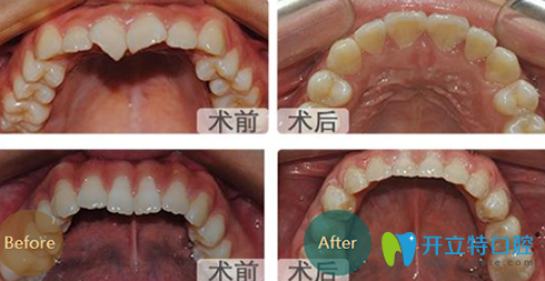 成都亞非牙科牙齒矯正前后效果對比圖
