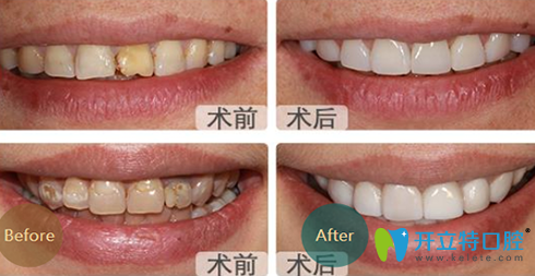 成都亞非口腔牙齒美白前后效果對比圖