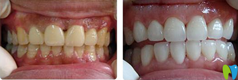 鄭州精益口腔牙齒美白前后對比圖