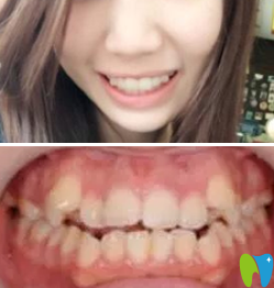 我在鄭州精益口腔做的牙齒矯正價格挺實惠 來看前后對比照