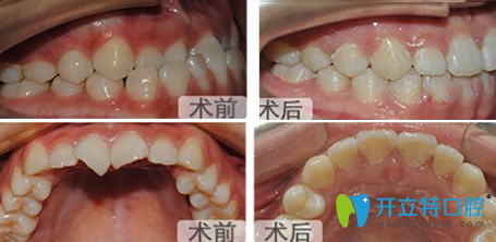 成都亞非牙科黃心建牙齒矯正前后效果對比圖