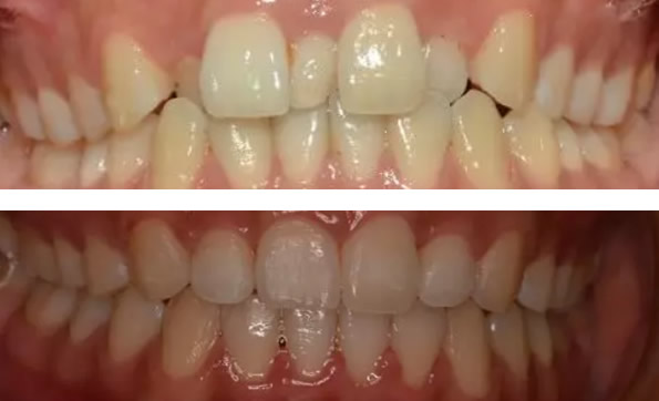 多生牙要拔嗎？看39歲白女士在武漢清華陽光口腔的正畸經(jīng)歷