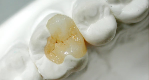 牙齒壞了怎么辦 嵌體修復(fù)和補(bǔ)牙哪個(gè)好 嵌體修復(fù)優(yōu)缺點(diǎn)大全