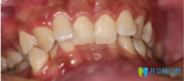 武漢愛齒爾口腔矯正牙齒前