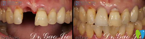 杭州科瓦口腔高杰單顆牙種植前后對比圖