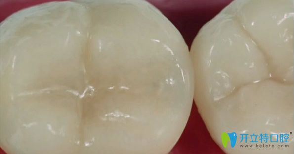 傳統(tǒng)補牙后牙齒壽命不長