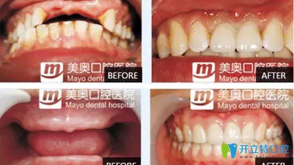 天津美奧口腔牙齒種植效果案例