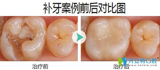 成都拜博口腔補(bǔ)牙案例前后對比圖