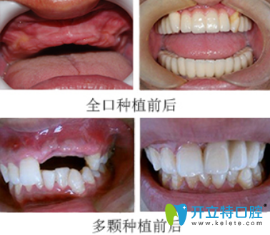 羅紹華全口牙種植+多顆牙種植案例前后對比圖