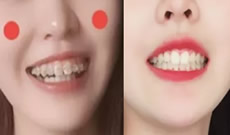 牙套剛畢業(yè)，分享我在成都拜博口腔矯正牙齒11個(gè)月來的體驗(yàn)