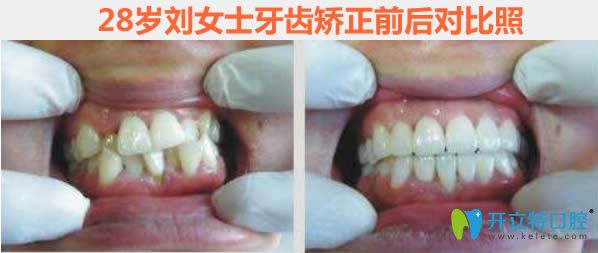 杭州蕭山至恒成年人牙齒矯正前后對比效果 杭州蕭山至恒成年人牙齒矯正前后對比效果