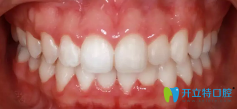 拜博口腔第11個月去掉牙套后牙齒照片