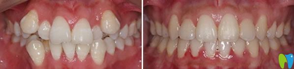 美奧口腔段婷牙齒矯正案例