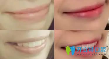 成都格林口腔牙齒正畸效果對比圖