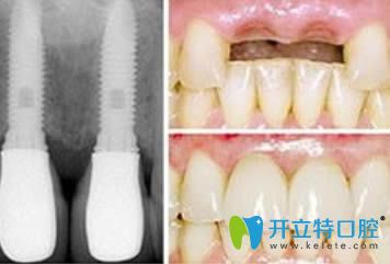 成都格林口腔<!--<i data=20240703-sp></i>-->忠院長種植牙案例圖