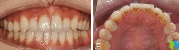 天津拜博口腔隱形矯正18個月后效果 天津拜博口腔隱形矯正18個月后效果