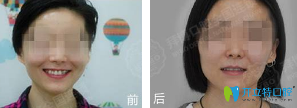 拜博口腔正畸前后效果對比 拜博口腔正畸前后效果對比