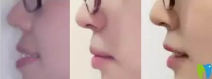 成都格林口腔門診隱適美牙齒正畸側(cè)面對比圖