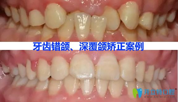 利爾口腔瀏陽分院牙齒錯(cuò)頜畸形矯正效果