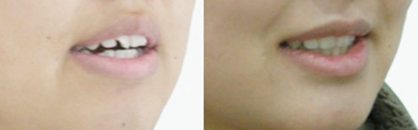 小孩齙牙怎么辦 我孩子在長沙優(yōu)伢仕口腔正畸案例可以參考