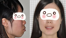 牙套畢業(yè) 分享在廣州圣貝口腔拔5顆牙做正畸2年半來的體驗(yàn)