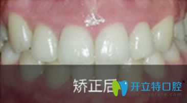 優(yōu)伢仕口腔矯正牙齒18個(gè)月效果