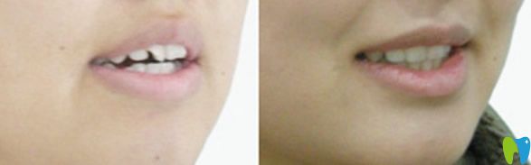 長(zhǎng)沙優(yōu)伢仕口腔矯正前后效果對(duì)比圖
