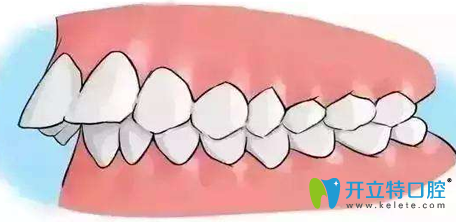 齙牙矯正多少錢要拔牙嗎，看廈門天使口腔矯正前后對比圖