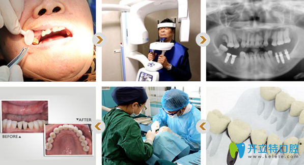 蘭春祥醫(yī)生種植牙的過程和效果