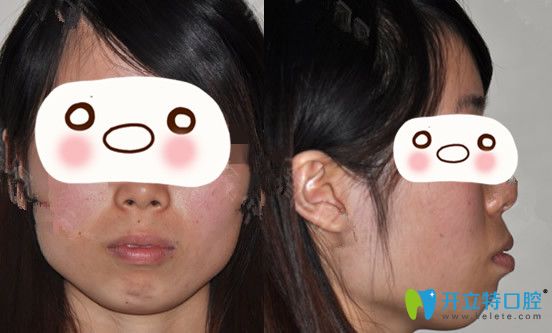 沒(méi)有找廣州圣貝口腔熊飛做正畸前的臉型照片 沒(méi)有找廣州圣貝口腔熊飛做正畸前的臉型照片