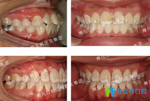 杭州博凡口腔盧海平齙牙矯正前后效果對(duì)比圖 杭州博凡口腔盧海平齙牙矯正前后效果對(duì)比圖