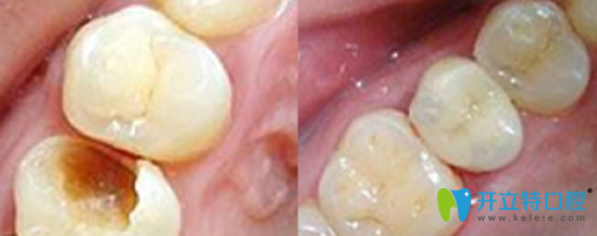 拜博口腔靠譜不？公布我的補牙治療前后對比圖