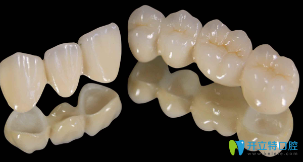 烤瓷牙適合牙齒斷裂修復(fù)