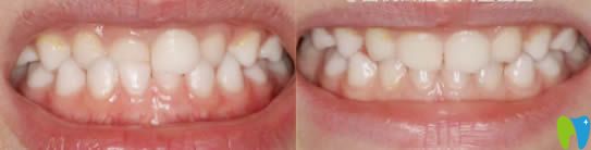 成都茁悅口腔李文星醫(yī)生兒童牙正畸效果對比圖