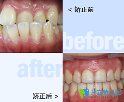 太原皓久口腔牙齒矯正前后效果對比圖 太原皓久口腔牙齒矯正前后效果對比圖