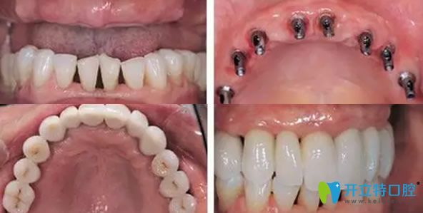 譚建武院長(zhǎng)牙齒種植案例