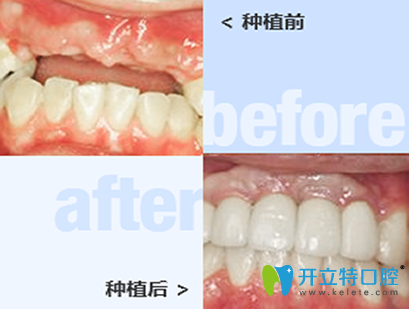 太原皓久口腔種植牙前后效果對比圖 太原皓久口腔種植牙前后效果對比圖