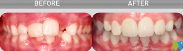 成都茁悅口腔青少年牙齒正畸效果圖