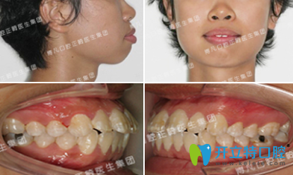 曬曬我找杭州博凡口腔盧海平院長(zhǎng)做隱形牙齒矯正前后照片