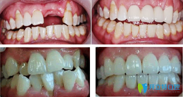 牙祖口腔種植牙+牙齒矯正效果案例