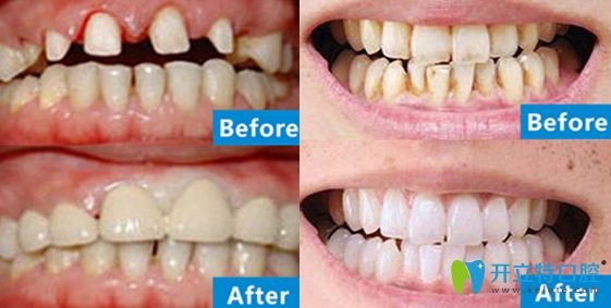 北極星口腔牙齒瓷貼面+牙齒冷光美白案例