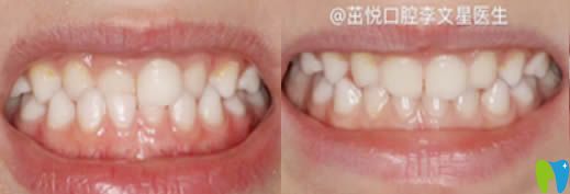 成都茁悅口腔門診6歲孩子矯正牙齒術后圖