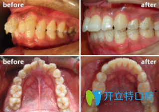 廈門登特口腔袁煒靈牙齒矯正前后效果對比圖