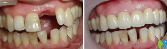 長沙美奧口腔黃穎醫(yī)生種植效果圖