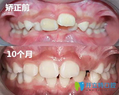 兒童MRC矯正案例對比圖