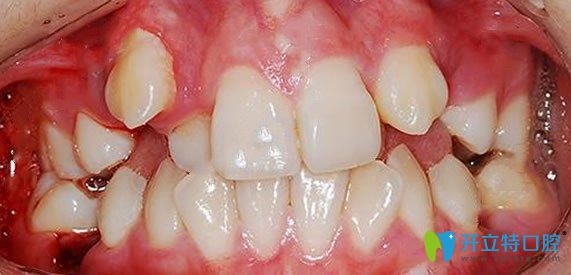 門牙不齊矯正前：