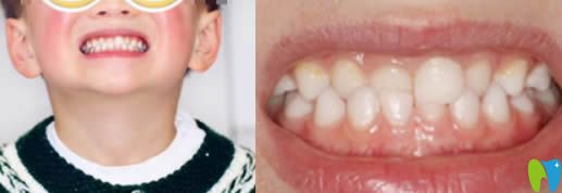 6歲孩子換牙期做牙齒正畸 成都茁悅口腔成功矯正了咬合錯(cuò)位