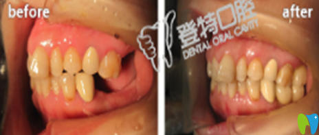 廈門(mén)登特口腔黃華生種植牙效果對(duì)比圖